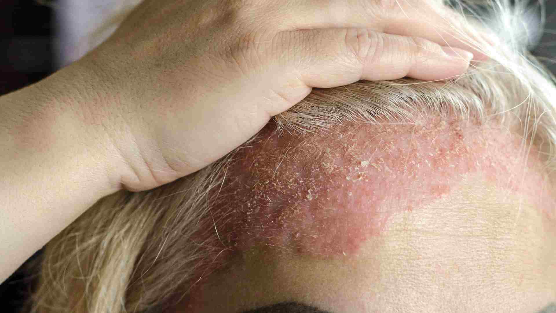 CBGA’s Emerging Evidence in Dermatological and Skin Disorders
